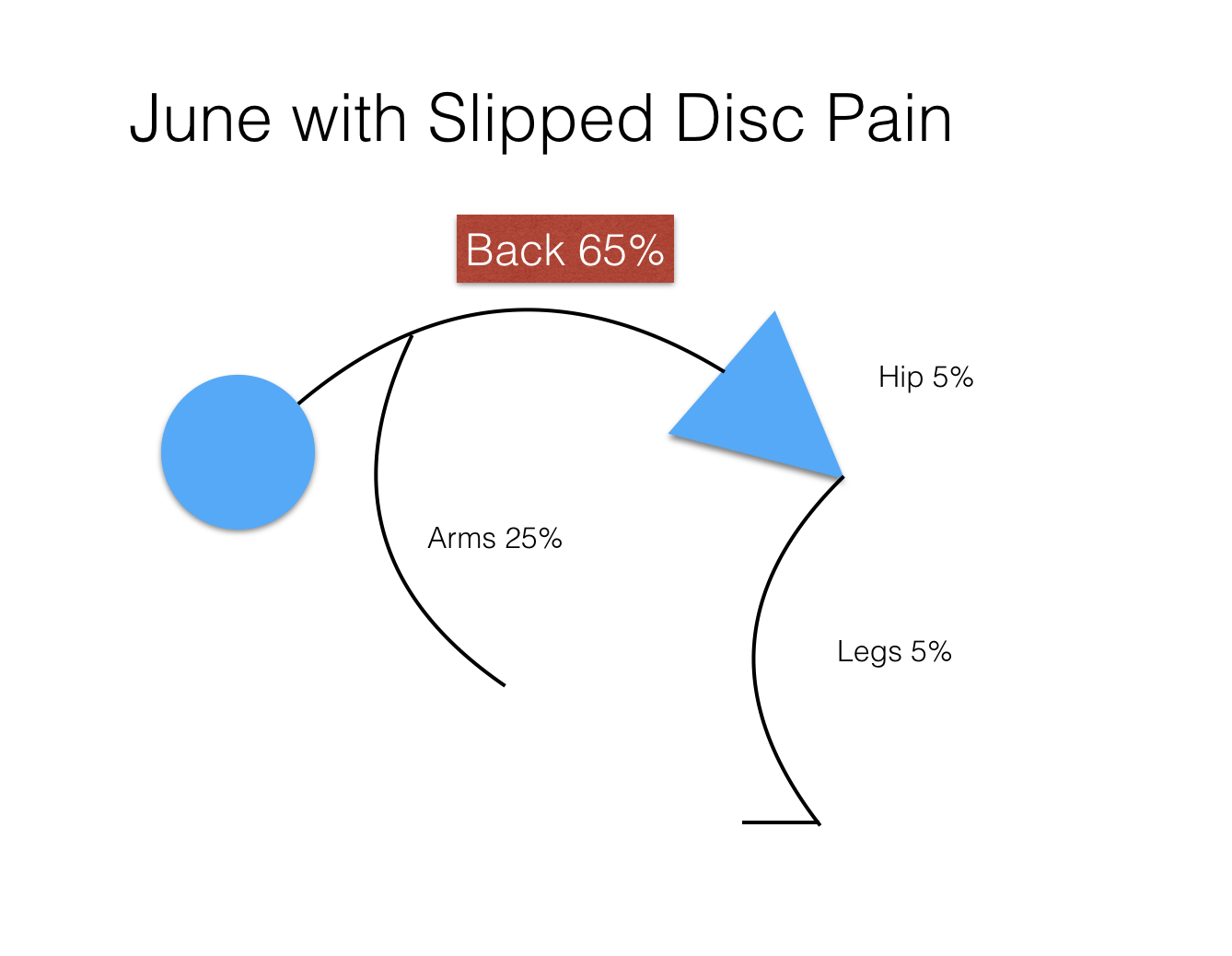 Slipped disc diagram explanation - slipped disk treatment Huddersfield
