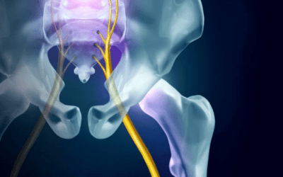 What Is Sciatica & How Can You Solve It?